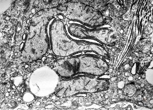 F,1y. | mitochondrial changes - Reye hepatocerebral syndrome